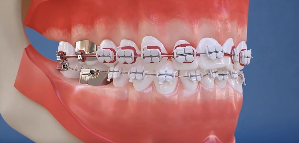 precio de brackets en estados unidos