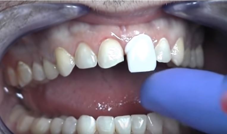 precio carillas dentales mexico