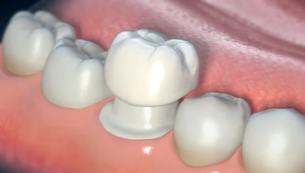 Corona dental Tipos y Precios en México 【 2022