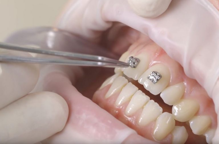 Precio de brackets autoligado Tratamientos dentales en México