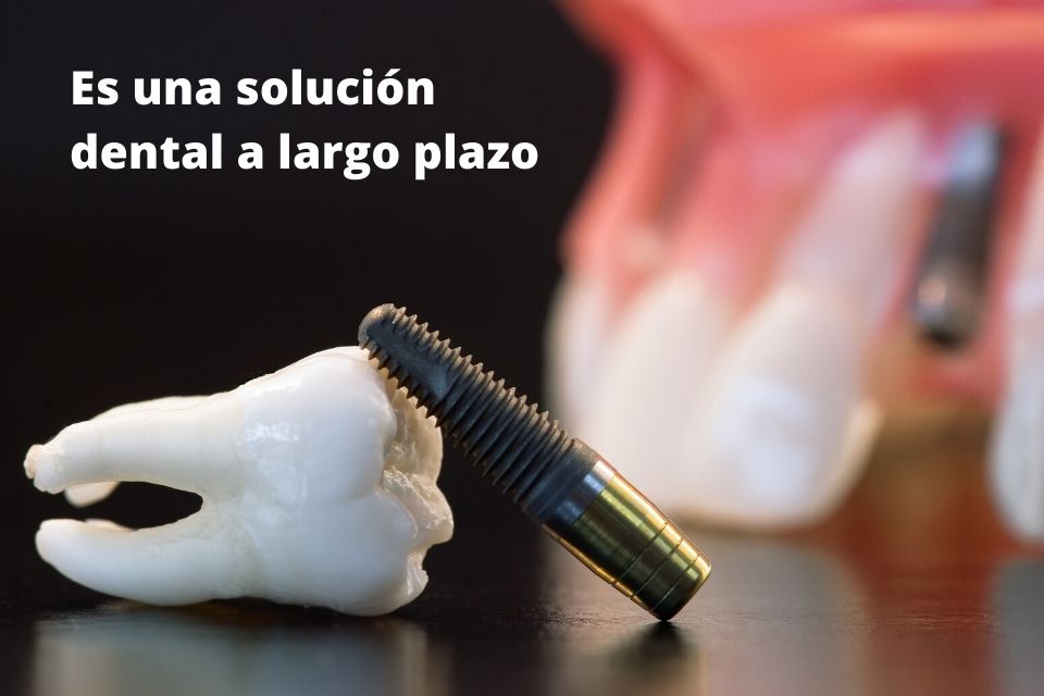 ventaja de un implante dental