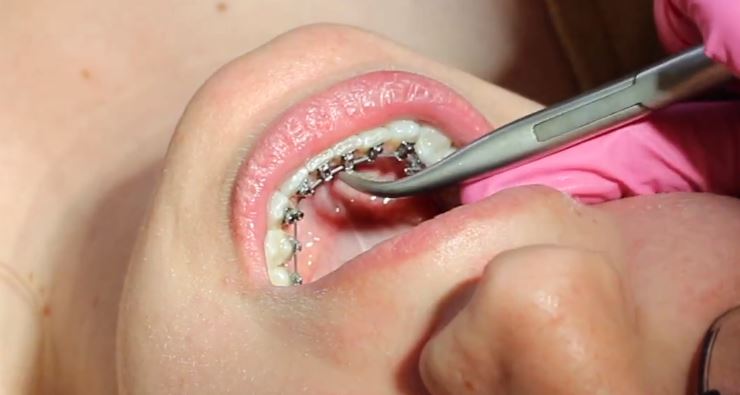 Cuanto cuesta los brackets linguales