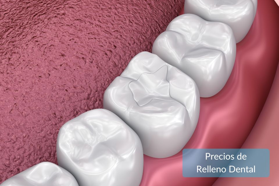 Precios de relleno dental en EE.UU