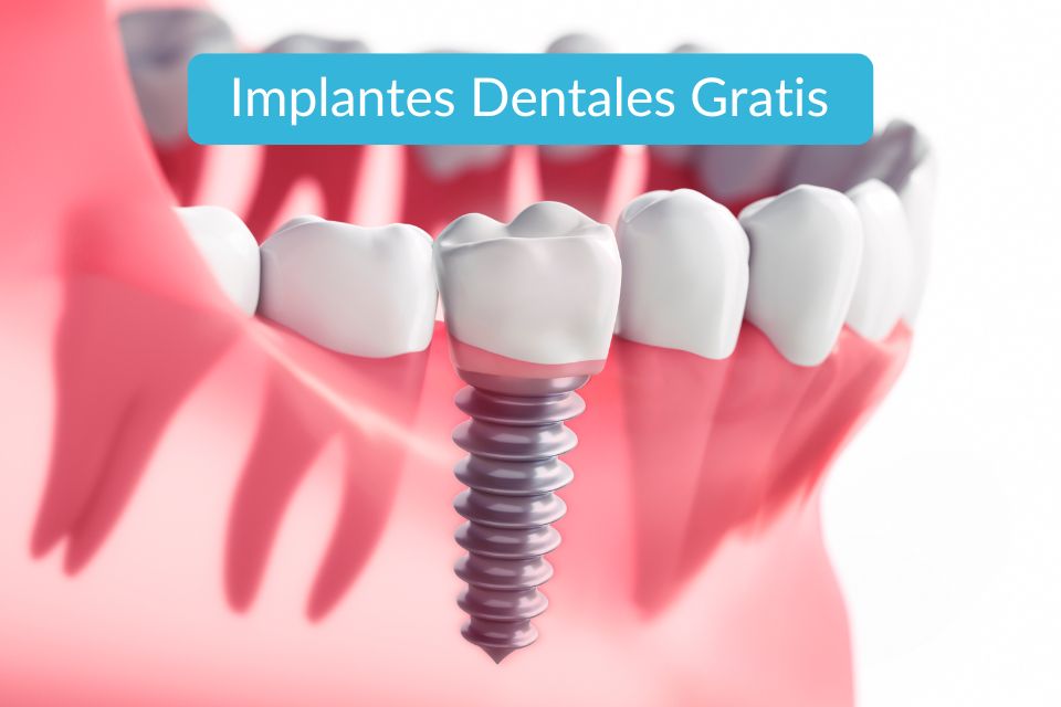 Implantes dentales gratis en EE.UU